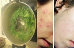 Công thức chuẩn nấu nước xông mặt giúp mụn ẩn tự trồi lên hết, da trắng bóc trẻ hơn 10 tuổi