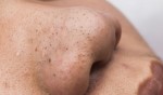Tuyệt chiêu tẩy sạch sành sanh mụn đầu đen đáng ghét