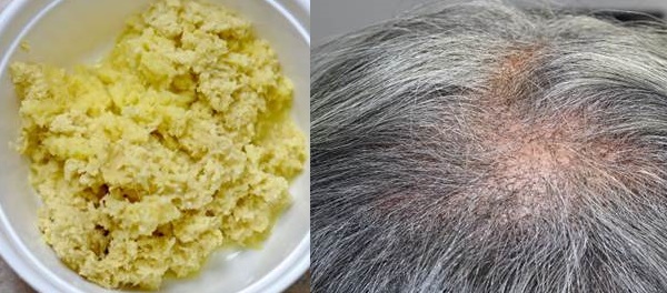 Tóc rụng gần hết cả đầu bỗng mọc dày mượt trở lại nhờ 2 công thức “độc nhất vô nhị” này