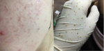 4 cách khiến mụn ẩn tự trồi lên khỏi cần nặn làm gì