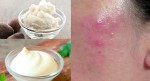 Đắp những thứ quen thuộc này lên mặt là da hỏng, bỏng ngay