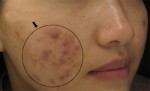 Da bị mụn hoài không hết do bạn mãi làm 7 thói quen này