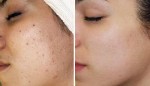 Cách trị mụn không tốn tiền mà phụ nữ nào cũng phải biết