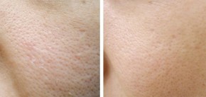 Mẹo thu nhỏ lỗ chân lông chỉ tốn 10 ngàn ai cũng phải biết