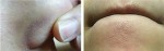 Mụn ở cằm và cánh mũi nhiều đến đâu cũng “chạy mất dép” sau 1 tuần dùng chuối xanh
