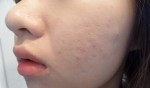 Dẹp sạch mụn ẩn chỉ trong một nốt nhạc khi uống loại nước này mỗi ngày