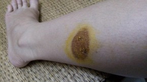 Chị em nào bị bỏng bô xe máy thì áp dụng ngay cách này để tránh sẹo thâm xấu xí