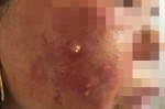 Mẹ và con gái ruột nhập viện sau tiêm thuốc làm trắng da
