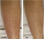 Hết sạch viêm lỗ chân lông nhờ công thức đơn giản bất ngờ với aspirin