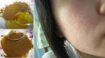 Bôi thứ này 2 lần/tối, các loại sẹo thâm, sẹo rỗ giảm 90% không cần bắn laser