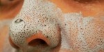 Trị mụn đầu đen ở mũi hiệu quả bất ngờ với công thức ít ai ngờ đến