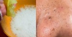 Thoa hỗn hợp này lên trên mặt, mụn đầu đen tự chui ra khỏi cần nặn đau đớn