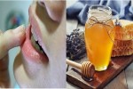 5 cách chữa môi khô nứt nẻ hiệu quả không cần son dưỡng