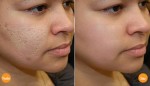 Sẹo thâm ở mặt hay chân tay lâu năm đến đâu cũng đều biến mất nhờ dùng 1 hũ hành tây ngâm mật ong