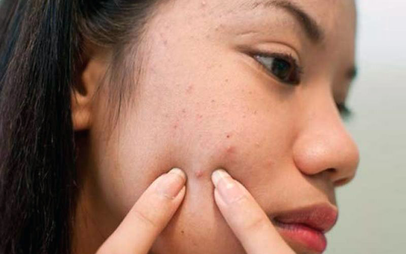 Nặn mụn bằng tay