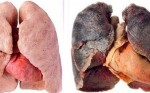 Bài thuốc có một không hai &rsquo;cứu&rsquo; phổi cho người nghiện thuốc lá