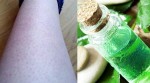 Trị khỏi VIÊM NANG LÔNG, NẶNG MẤY CŨNG GIẢM với các hỗn hợp rẻ tiền này