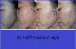 FA suốt 5 năm vì mụn bỗng điều kỳ diệu xảy ra chỉ nhờ cách này