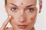 Nên ăn gì, uống gì để giảm quá trình nám da?