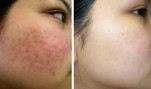 Đánh bay hoàn toàn mụn, nếp nhăn, sẹo và quầng thâm với thần dược bột nghệ