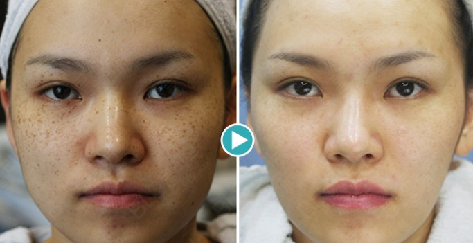 Phân loại các mức độ nám da và các biện pháp điều trị tối ưu