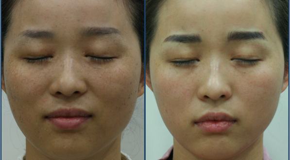 Trị Nám Bằng Dược Mỹ Phẩm Tại Sao Không