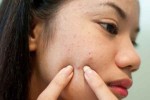 Chia sẻ kinh nghiệm trị hết mụn bằng 6 thứ có sẵn trong bếp