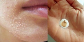 7 bước trị dứt mốc da mặt mùa đông cực hiệu quả