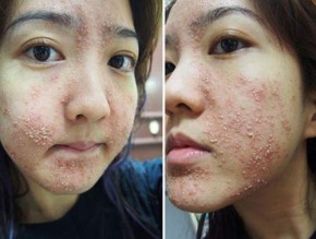 Làn da bị phá hủy vì thói quen dùng dầu dừa sai cách của hàng 1000 chị em