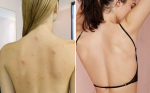 3 cách trị mụn ở lưng đơn giản nhất nhưng không phải ai cũng biết