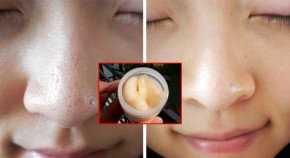 Cách lấy mụn đầu đen ẩn sâu “CHẮC CHẮN SẠCH 100%” ai từng làm đều đã thành công