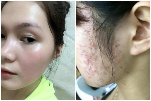 Mụn mảng, viêm da đều biến mất nếu đắp hỗn hợp này trong 15 phút