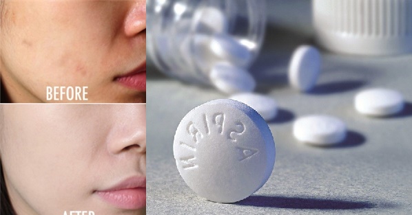 Dùng 5 viên aspirin như thế này da trắng ngay chỉ trong lần đầu tiên