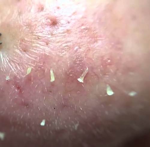 Diệt tận gốc rễ mụn đầu đen ở cằm và 2 bên cánh mũi chỉ sau 1 lần sử dụng