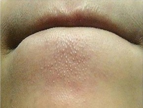 Xóa sổ tận gốc mụn ẩn, mụn cám, mụn li ti cả vết thâm nhờ rửa mặt bằng nước lá trầu không cực đơn giản