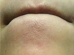 Xóa sạch mụn ẩn, mụn cám ở cằm với cách làm đơn giản