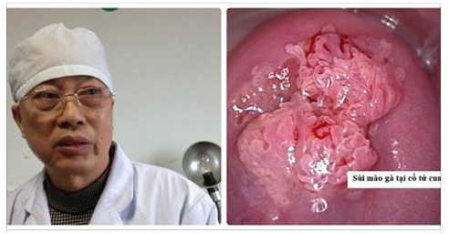Bác sĩ cảnh báo con đường gây bệnh sùi mào gà bất ngờ, chị em ai cũng cẩn thận