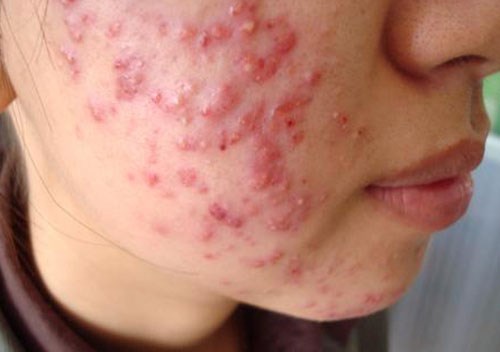 Dùng tỏi theo cách này, mụn mủ, mụn bọc, sưng tấy đến mấy cũng tiêu biến tức thì