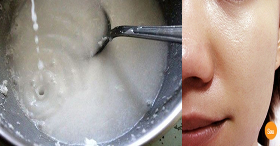 Trộn nước dừa và mật ong rồi thoa lên mặt, sẹo và vết thâm sẽ dần dần biến mất, cực kỳ hiệu quả