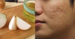 1 củ hành tây có ngay 3 mẹo làm đẹp rẻ tiền giúp bạn lột xác hoàn toàn