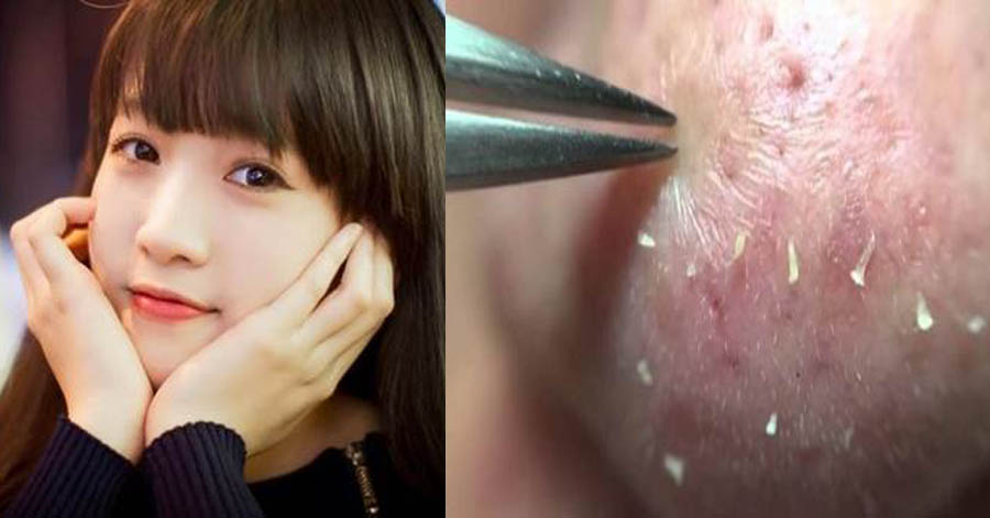 Đây chính là cây nhíp gắp mụn đầu đen thần thánh đang được chị em quan tâm