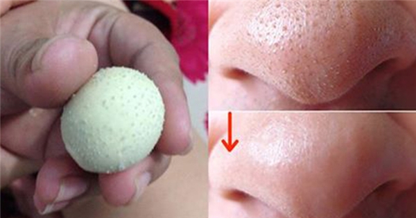 Hết mụn đầu đen ở mũi chỉ sau 5 phút ngay tại nhà với cách này