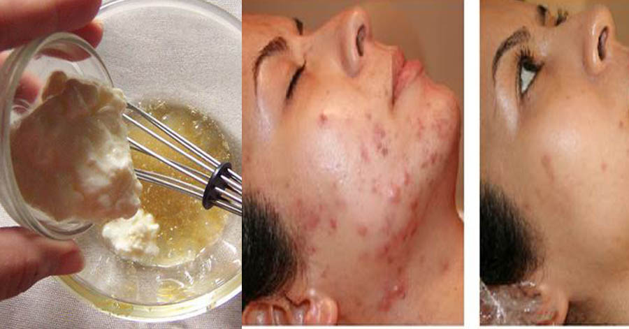 Đắp hỗn hợp này 2 tuần, thâm mụn cứng đầu cỡ nào cũng mờ đi trông thấy