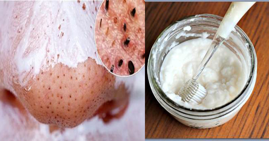 Trộn muối với kem đánh răng rồi chà lên mũi, mụn đầu đen tự khắc chui ra không cần nặn