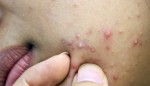 Đánh bay mụn trứng cá ở tuổi dậy thì siêu nhanh, siêu an toàn