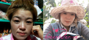 Bị nám sâu và lan rộng vậy mà giờ đây da dẻ tôi còn đẹp hơn ngày xưa rất nhiều