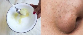 Mặt nạ thần kỳ giúp tẩy sạch lông và mụn đầu đen trên mặt ngay tức khắc