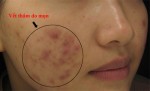 Cách trị thâm mụn lâu năm bằng việc bổ sung dinh dưỡng từ trong cơ thể
