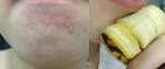Hết sạch mụn trong 4 ngày nếu bạn làm điều này 5 phút mỗi ngày