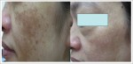 Xóa sổ nỗi “ám ảnh” nám da, tự tin thay đổi diện mạo trẻ trung, hạnh phúc mỗi ngày